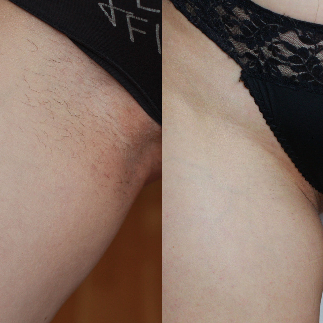 Hårborttagning med laser före och efter bikinilinje